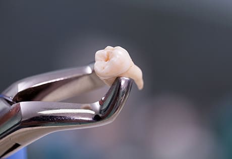 歯を失った部分に自分の歯を移植する治療「歯牙移植」